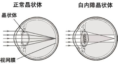 白內障為何會影響視力