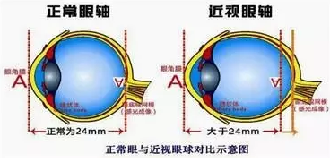 近視眼球突出？！控制近視度數(shù)加深是關(guān)鍵！
