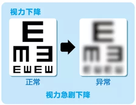 視網(wǎng)膜脫離啥癥狀？這張圖告訴你！