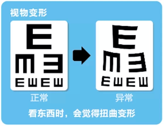 視網(wǎng)膜脫離啥癥狀？這張圖告訴你！