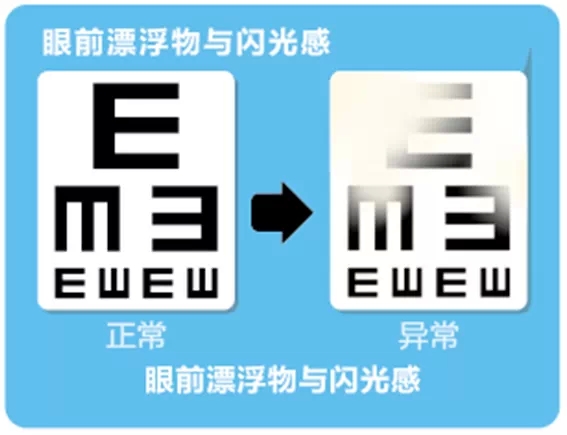 視網(wǎng)膜脫離啥癥狀？這張圖告訴你！