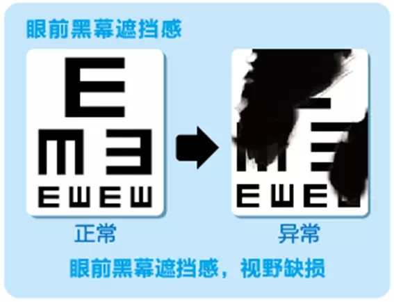 視網(wǎng)膜脫離啥癥狀？這張圖告訴你！