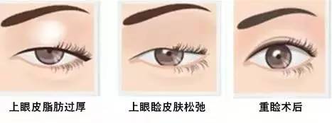 為什么要做雙眼皮？5個(gè)理由說(shuō)服你！
