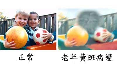 黃斑變性與老花眼，兩者不一樣！