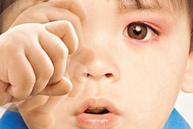 秋季紅眼病高發(fā)，當心孩子被傳染