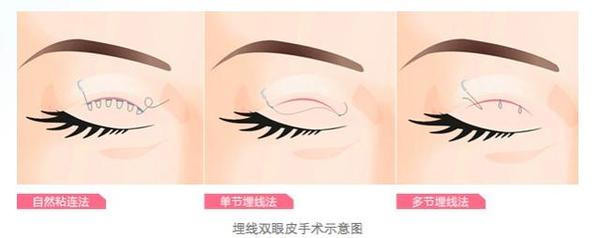 眼整形的恢復(fù)期是多長？你肯定想知道！