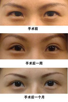 眼整形的恢復(fù)期是多長？你肯定想知道！