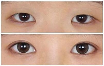眼整形的恢復(fù)期是多長？你肯定想知道！