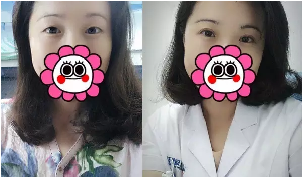 要不要做雙眼皮？別糾結(jié)了看這個(gè)！