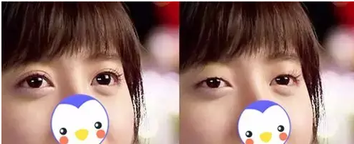 要不要做雙眼皮？別糾結(jié)了看這個(gè)！