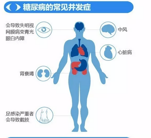 你造嗎？糖尿病晚期眼睛會(huì)致盲！