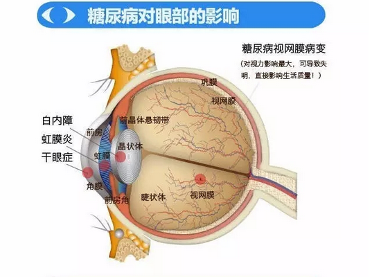 你造嗎？糖尿病晚期眼睛會(huì)致盲！