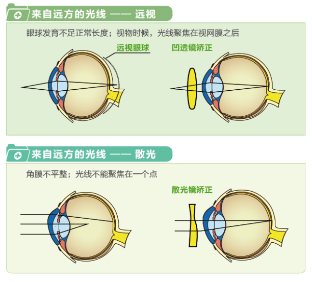 【看圖解】一張圖教你看懂近視、遠(yuǎn)視和散光