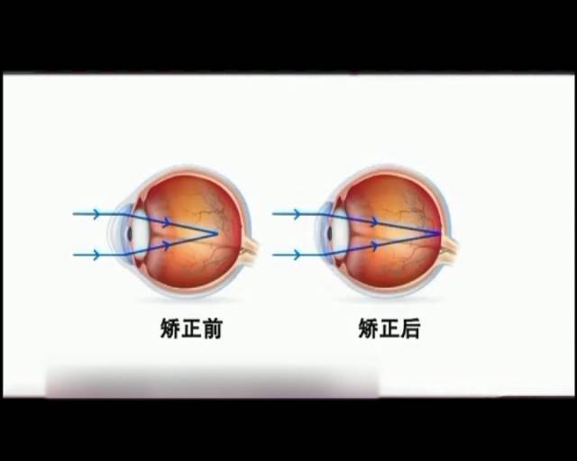一夜之間真的能改變視力嗎？