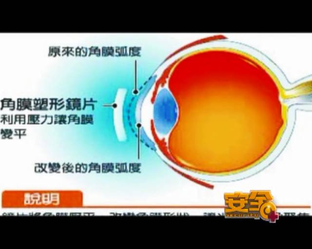 一夜之間真的能改變視力嗎？
