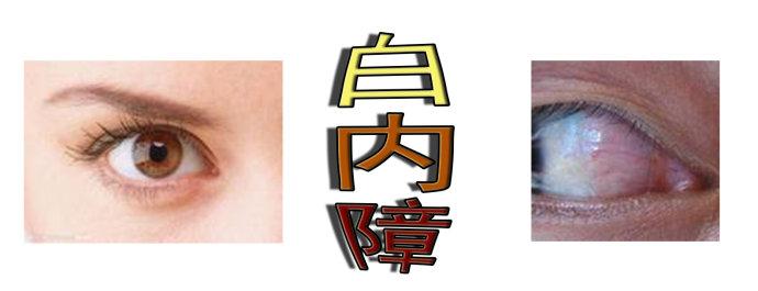 白內障手術會反復嗎？