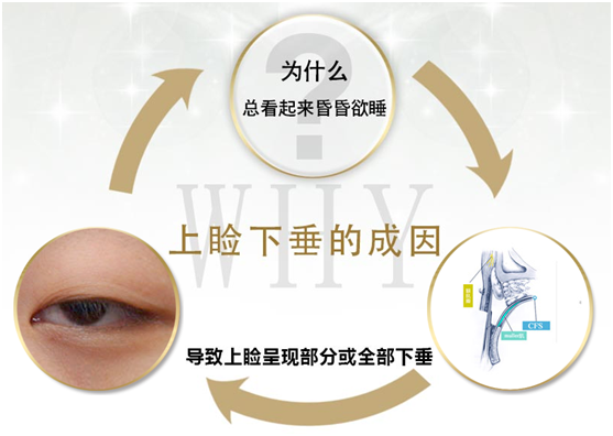 拯救惺忪睡眼，告別上瞼下垂！