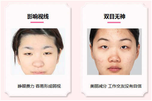 拯救惺忪睡眼，告別上瞼下垂！