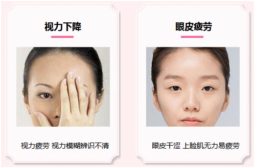 拯救惺忪睡眼，告別上瞼下垂！