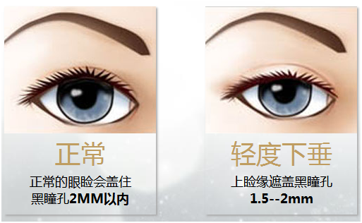 拯救惺忪睡眼，告別上瞼下垂！