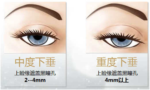 拯救惺忪睡眼，告別上瞼下垂！