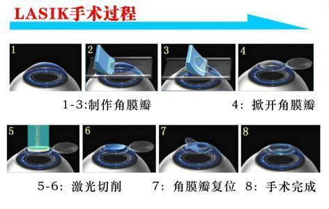 他們很有錢，但寧愿戴眼鏡都不做近視手術(shù)
