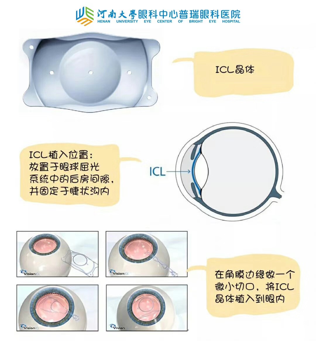 近視度數(shù)太高，還能做手術(shù)嗎？
