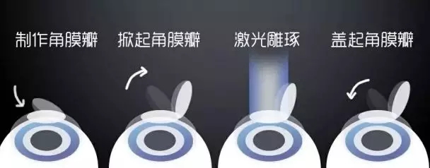 激光近視矯正和ICL晶體植入近視矯正攻略，