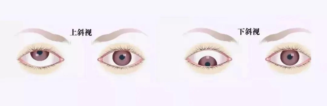 關(guān)于斜視，這幾個誤區(qū)害人不淺!