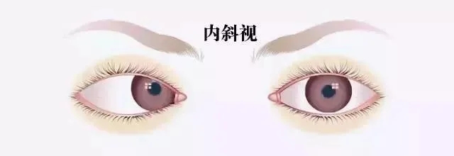 關(guān)于斜視，這幾個誤區(qū)害人不淺!