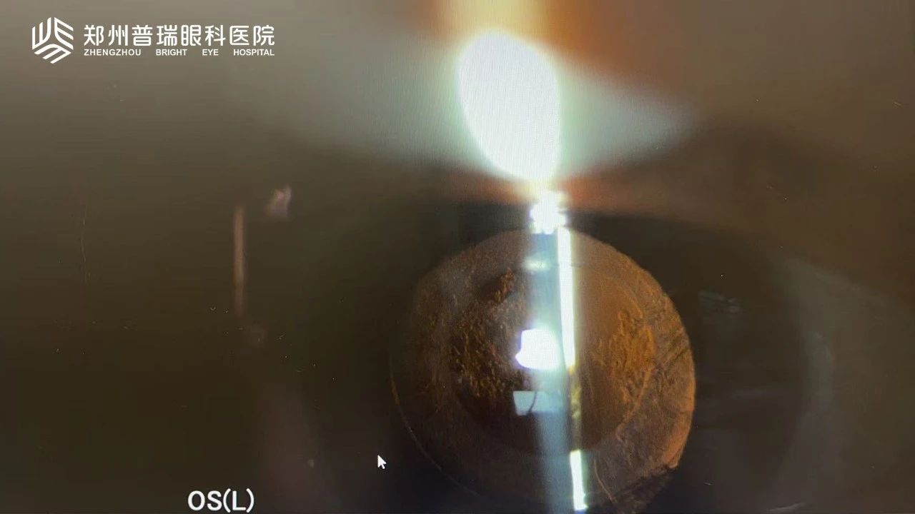 白內(nèi)障術(shù)后視力又下降？6大原因多方面解析！